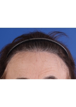 After Hair Transplant&nbsp;Hairline